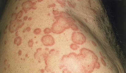 What to look for with  drug-induced urticaria