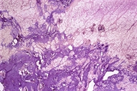 Rickets is caused by a deficiency of vitamin D, which is required for normal calcium absoprtion.