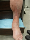 Painful tightening  of the skin on the legs