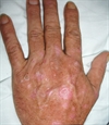 Atrophic rash in a  patient with hepatitis C