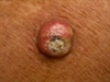 Rapidly growing tumor on the forearm