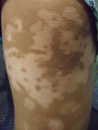 Depigmented Patch Skin