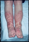 Flesh-colored nodules on the shins and feet