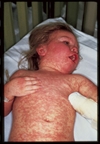Rash preceded by  fever and cough