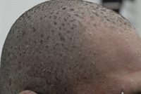 Scaly plaques spread from head to toe