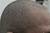 Scaly plaques spread from head to toe