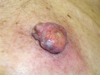 Enlarging back and shoulder lesions