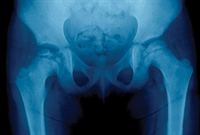 Figure 1. X-ray shows dislocation of the left hip in a 5-year old girl.
