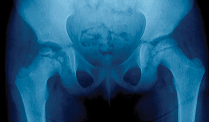 Common pediatric hip  diseases in primary care