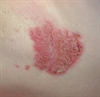 Recurrent erosions on the neck and axillae