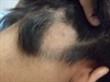 Patches of hair loss