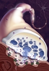 When to start plasmapheresis in a patient with myasthenia gravis