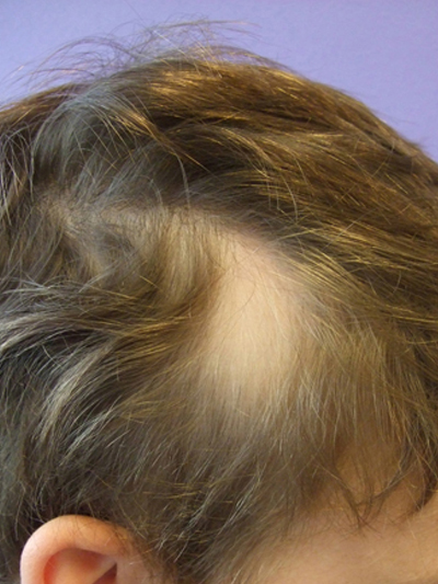 Patches Of Hair Loss The Clinical Advisor 