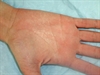 Exposure to moisture leads to palmar rash