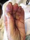 Tender, edematous, red plaques on a woman's hands and feet
