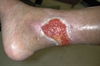 Cutaneous lesions