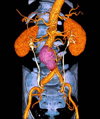 CT scan shows an abdominal aortic aneurysm above the aortoiliac junction. CT scan shows an abdominal aortic aneurysm above the aortoiliac junction.