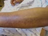 Pain and hardening of the skin constricts shoulder movement
