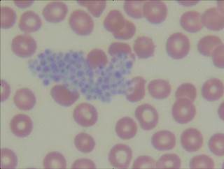 FIGURE 1. Platelet clumping (blue) was seen on peripheral blood smear. FIGURE 1. Platelet clumping (blue) was seen on peripheral blood smear.