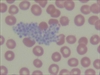 Blood-collection device leads to low platelet count