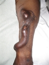 Endoscopic surgery for fistula creation