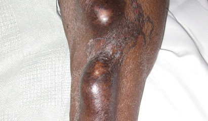 Endoscopic surgery for fistula creation