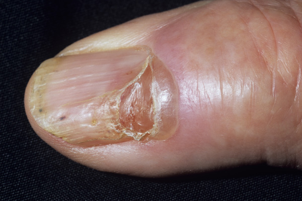 Nail Cyst