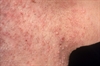 Folliculitis