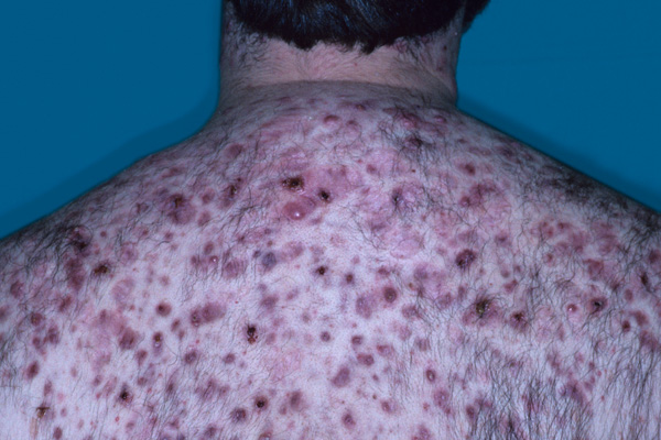 Folliculitis in Adults: Condition, Treatments, and ...