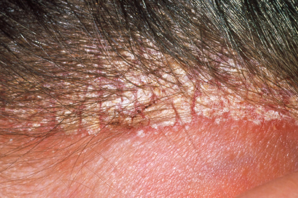 Eyebrow Dandruff Causes, Seborrheic, Malassezia, Eczema ...