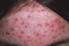 Acne vulgaris