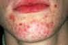 Acne vulgaris