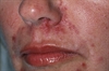 Acne rosacea