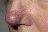 Acne rosacea