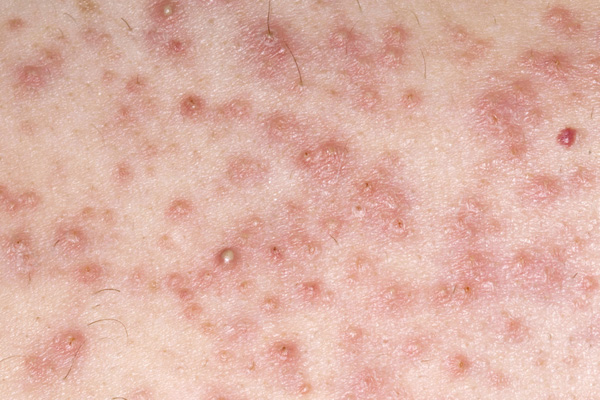 Inflamed Hair Follicles On Penis 30