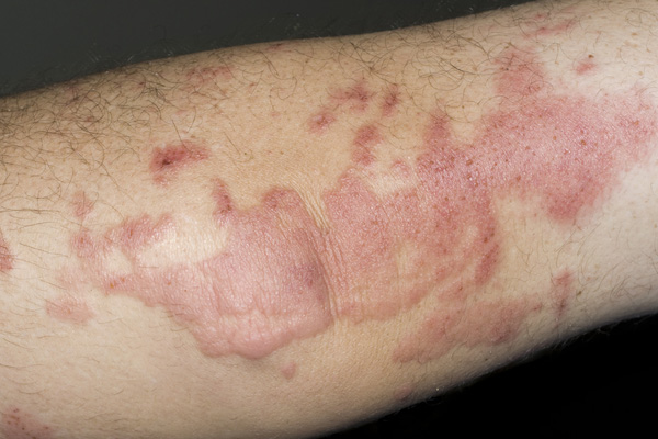 red patches on skin 