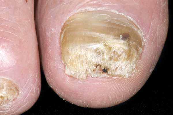 Nail Diseases | Fingernails | MedlinePlus