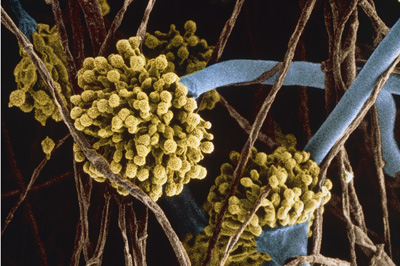Lungs could be latest casualty of diabetes