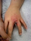 Botched cryotherapy procedure leads to painful bullous lesion