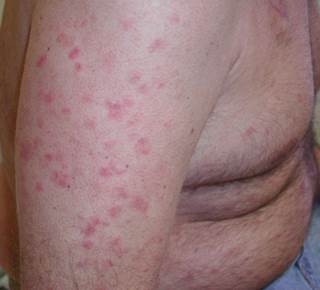 skin lesions on arms | Lifescript.com