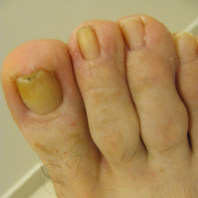 bilateral foot fungus icd 10