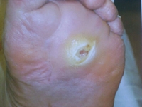 Fig. 1 The patient was initially hospitalized for treatment of cellulitis and a left plantar foot ulcer.