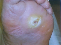 Plantar Ulcer