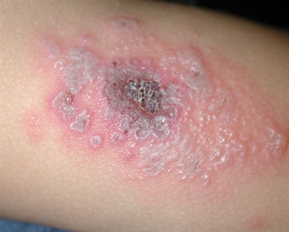 common spider bites in florida. spider bite pictures symptoms.