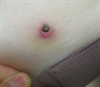 Papules caused by insect bites