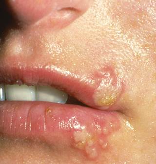 Mouth Blister Pictures 18
