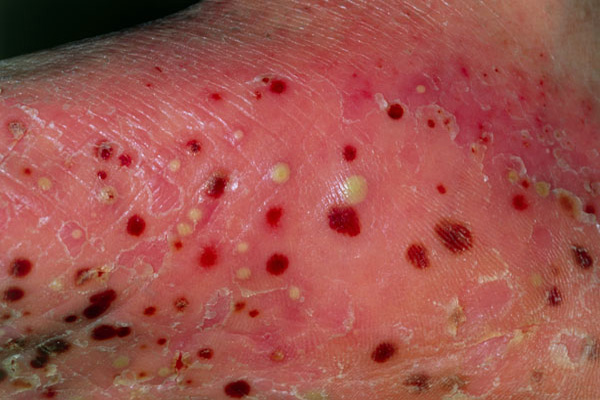 Psoriasis 