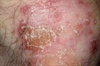 Psoriasis