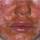 Impetigo Impetigo