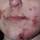 CA-MRSA on face CA-MRSA on face
